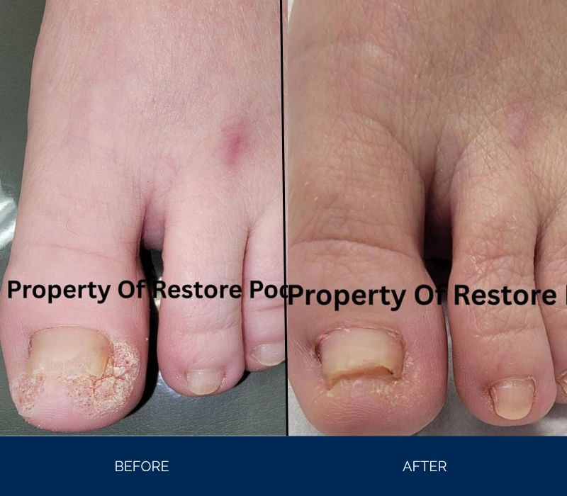 Before and after comparison of toenails showing fungal infection treatment results