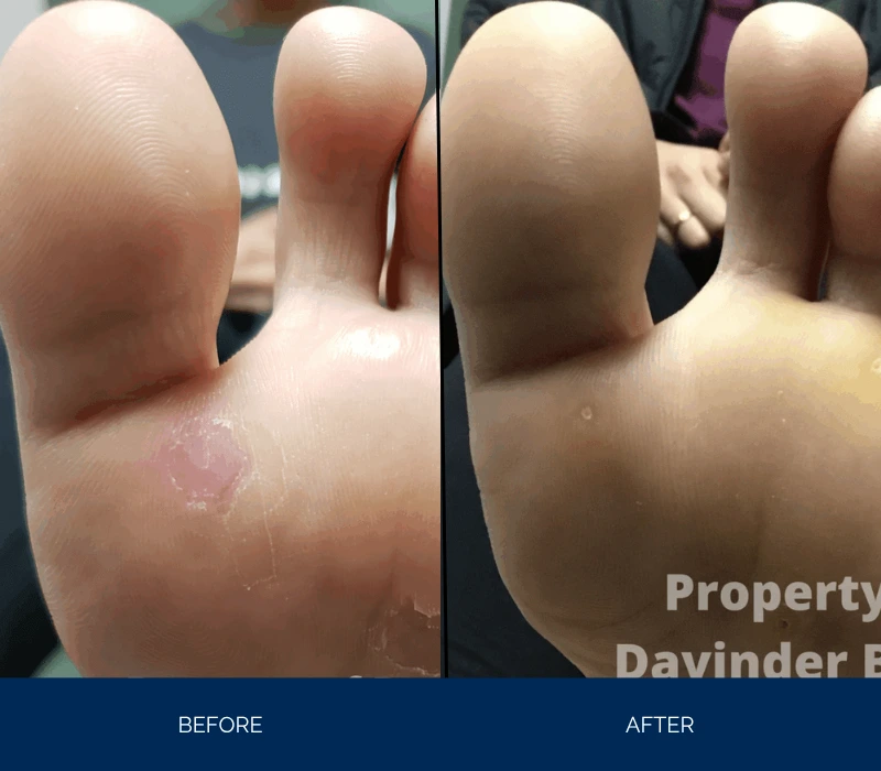 Before and after comparison of heel with reduced swelling and improved skin texture