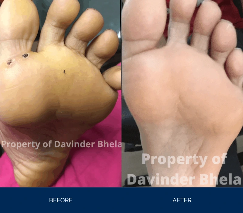 Before and after comparison of foot sole showing reduced swelling and discoloration
