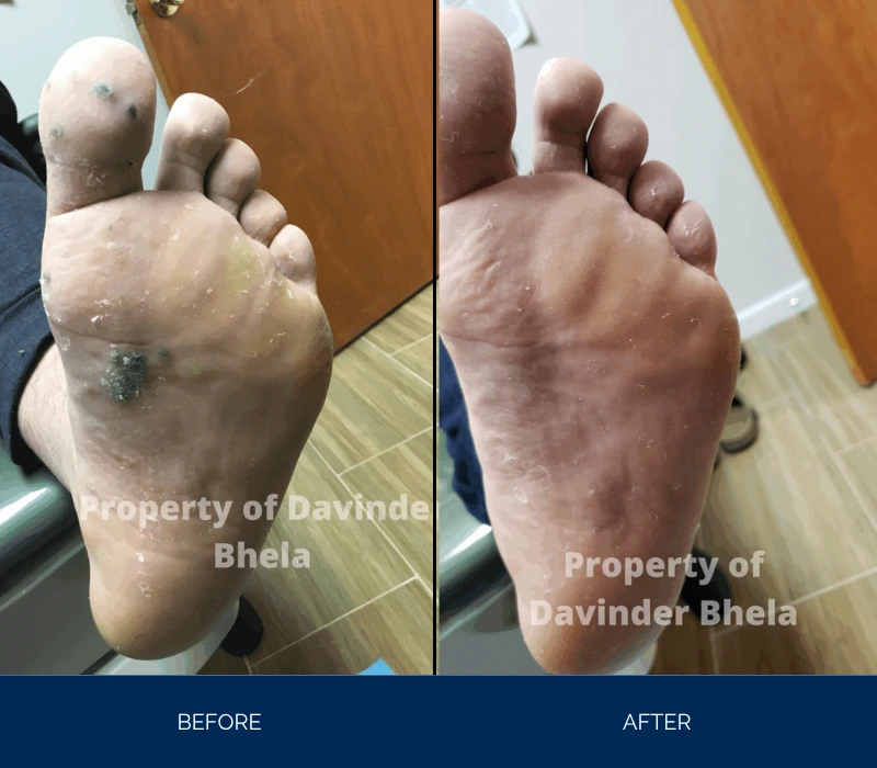 Before and after comparison of foot sole with improved skin appearance and reduced marks