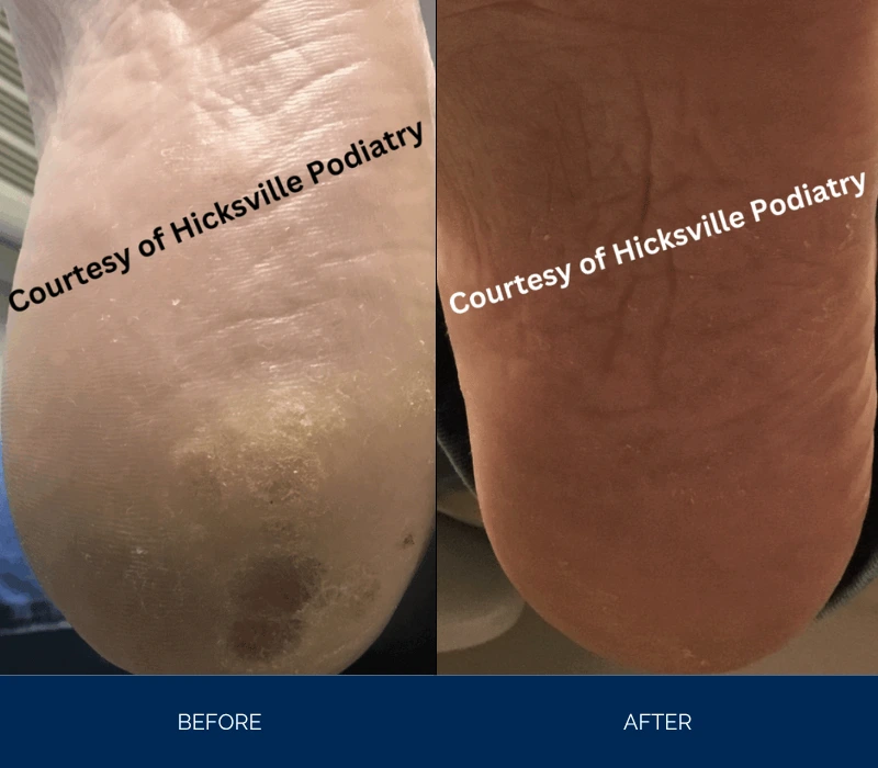 Before and after comparison of heel sole showing reduced dark spots and improved skin clarity
