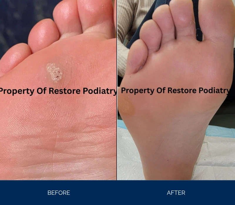 Before and after comparison of child's foot sole with resolved wart