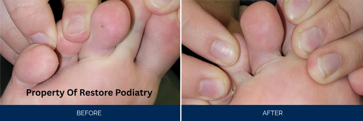 Before and after comparison of child's toes showing improved nail appearance