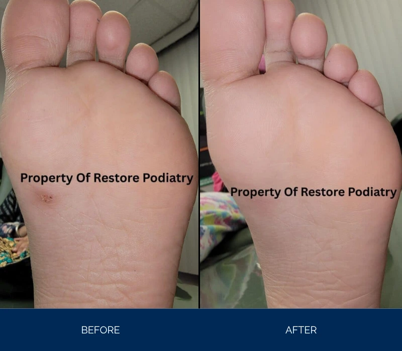 Before and after foot sole treatment showing reduced swelling and improved skin texture