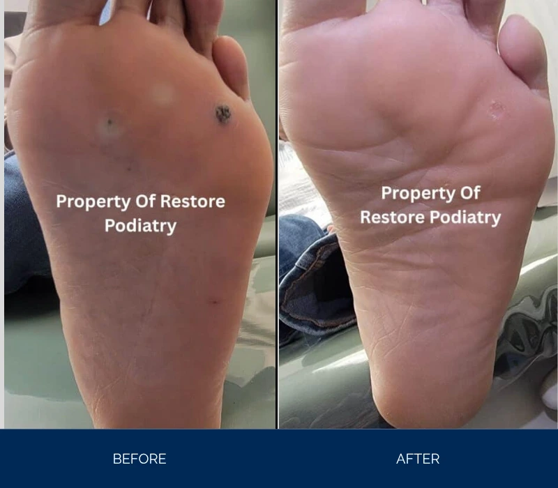 Before and after foot sole showing decreased inflammation and smoother skin appearance