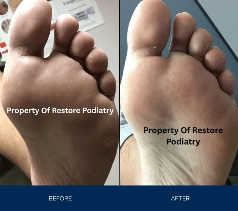 Before and after foot plantar view showing swelling reduction, left foot with puffiness and right foot with normal contour