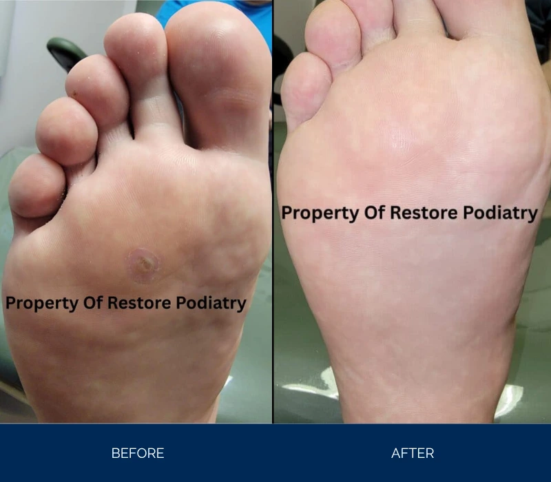 Before and after foot showing reduction in swelling and improved overall appearance