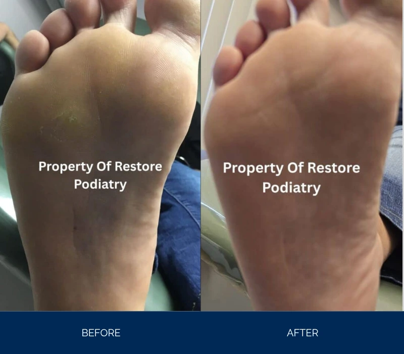 Before and after foot sole demonstrating decreased puffiness and improved skin clarity