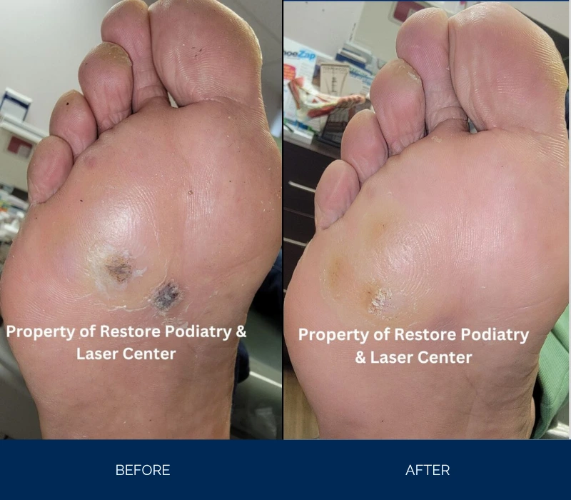 Before and after foot sole showing laser treatment results with reduced spots and improved texture