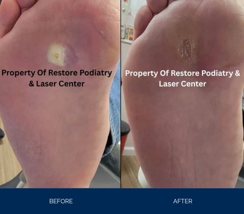 Before and after foot sole showing laser treatment with reduced lesion and clearer skin