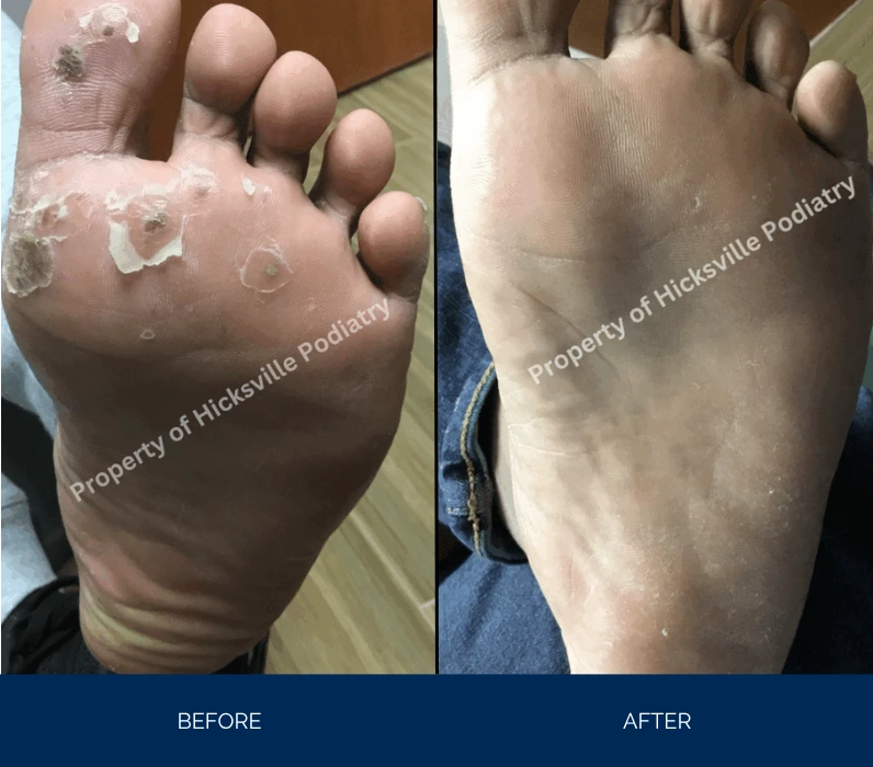 Before and after foot plantar view showing resolution of peeling skin lesions, left foot with white scaling patches healed to smooth skin