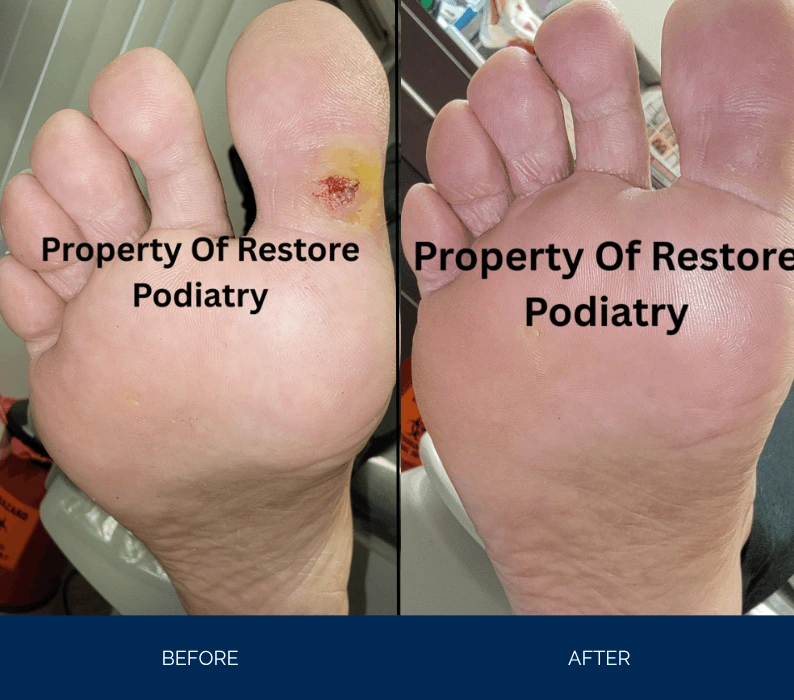 Before and after foot plantar view showing resolution of wound with blood crusting on left side versus healed skin on right