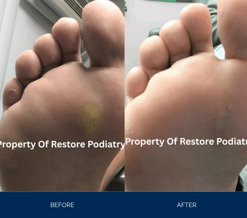 Before and after foot plantar view showing healing of lesion, left foot with yellow discolored spot progressing to clear skin on right