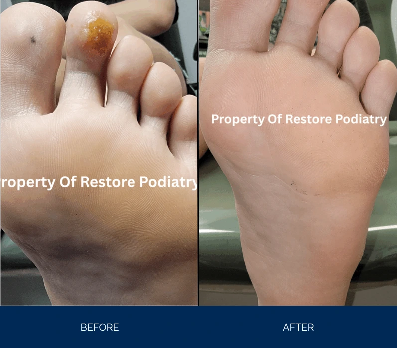 Before and after comparison of foot showing wart treatment results on second toe