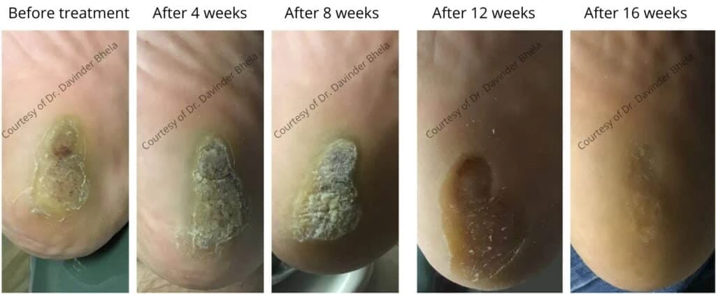 Wart treatment progression over 16 weeks from initial lesion to healing stages