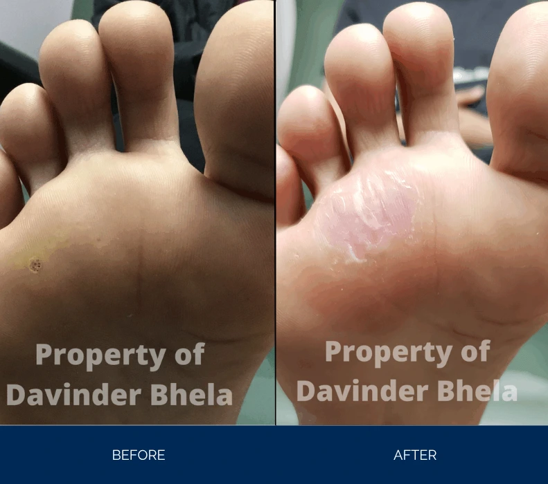 Before and after comparison of plantar wart treatment on ball of foot