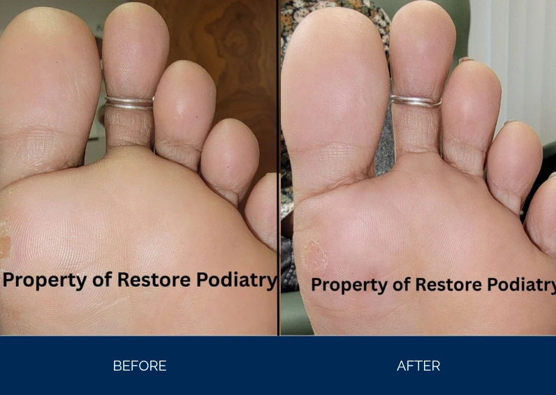Before and after comparison of foot showing reduced swelling and skin improvement