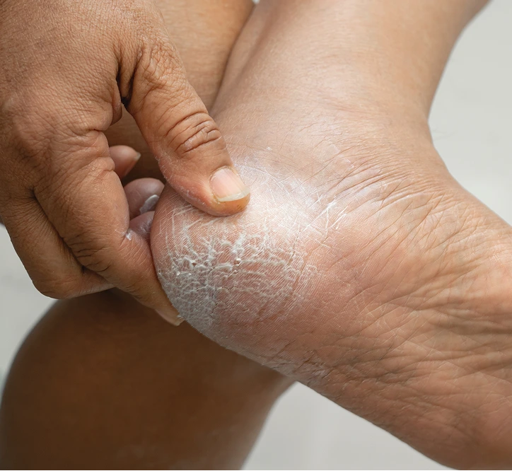 Hand pointing to dry, cracked skin on heel of foot