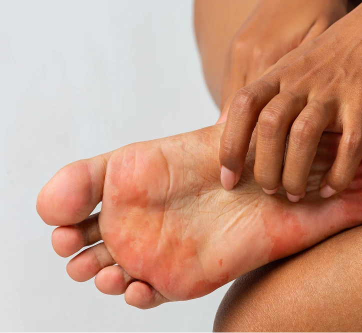 Swollen and inflamed foot showing redness and heat from infection