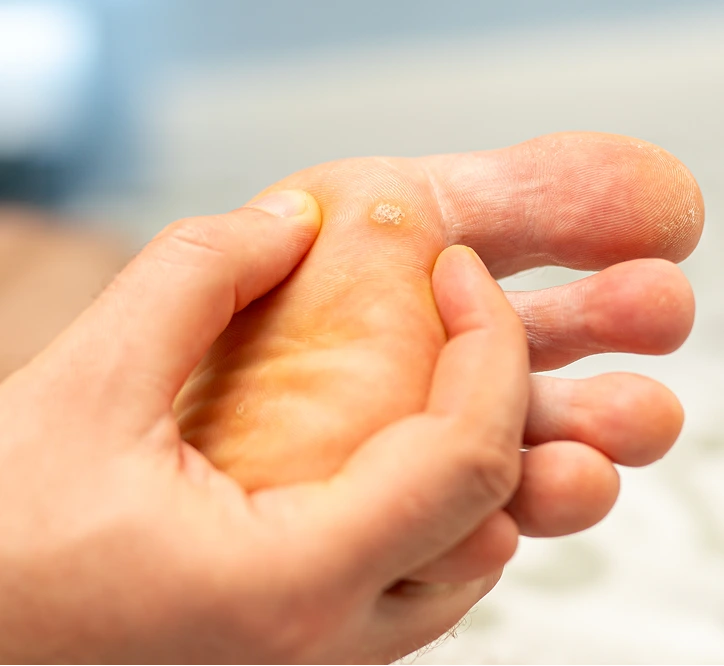 Close-up of a foot showing a wart on the toe with visible bumpy texture