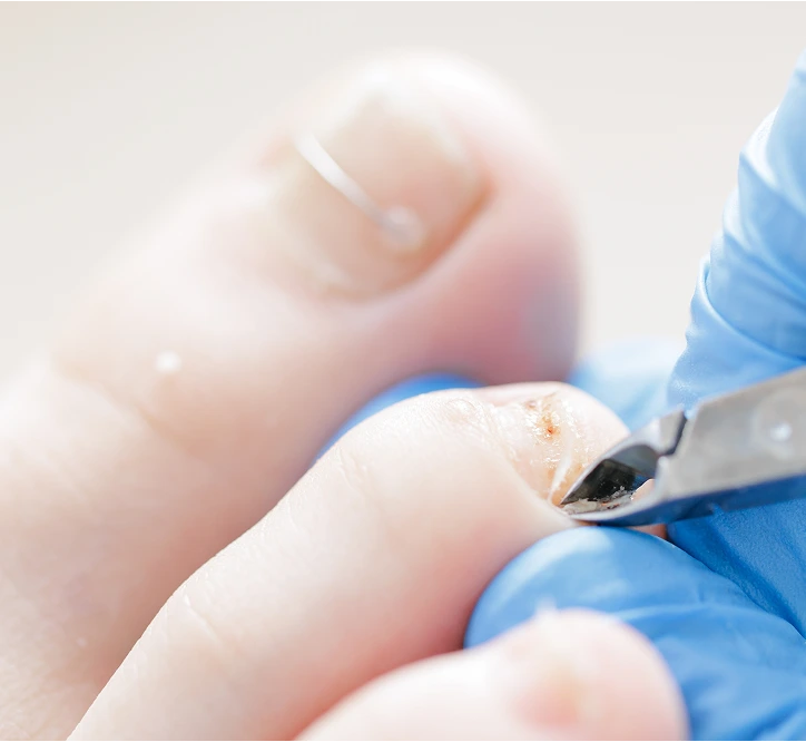 Podiatrist using a medical instrument to remove a wart from a patient's foot