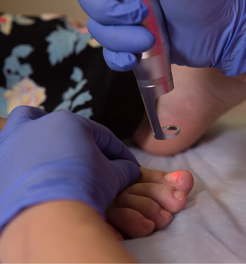 Podiatrist in blue gloves using handheld laser device on patient's foot