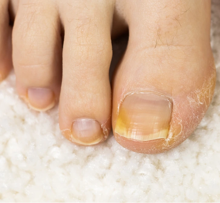 Toenails with yellow discoloration and thickening from fungal infection on white sand