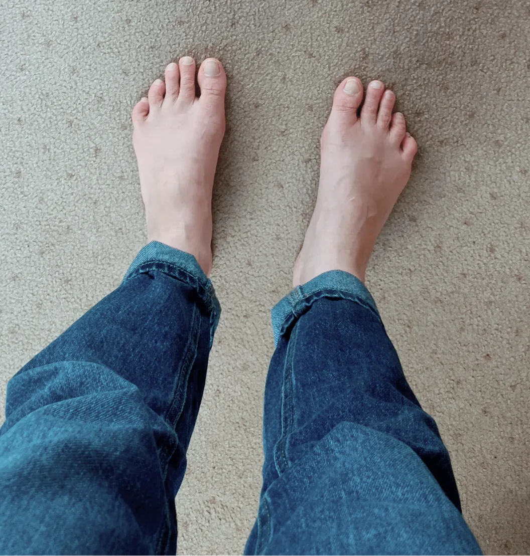 Person's swollen feet and ankles viewed from above while standing on carpet