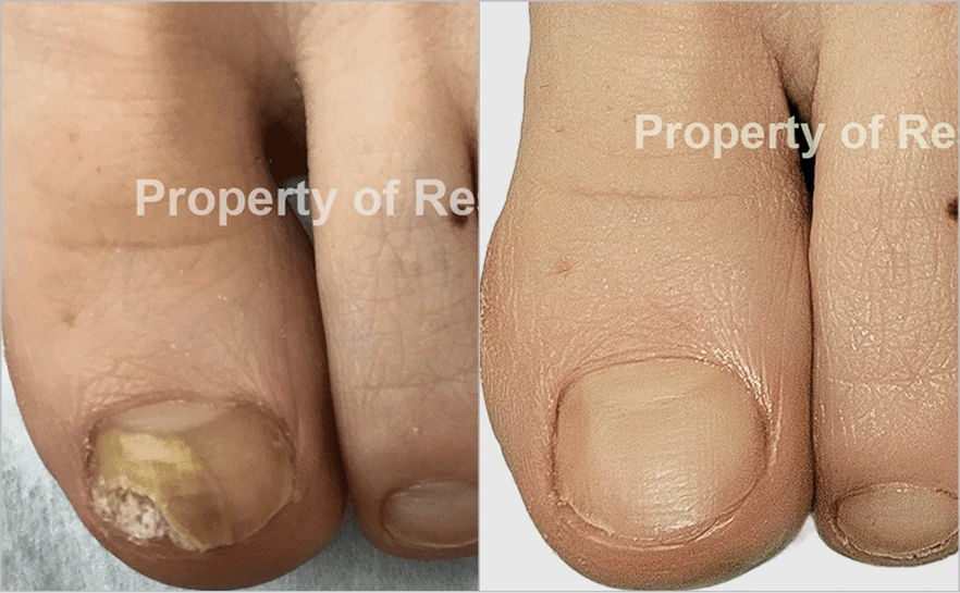 Before and after toenail treatment showing discolored diseased nail restored to clear healthy nail
