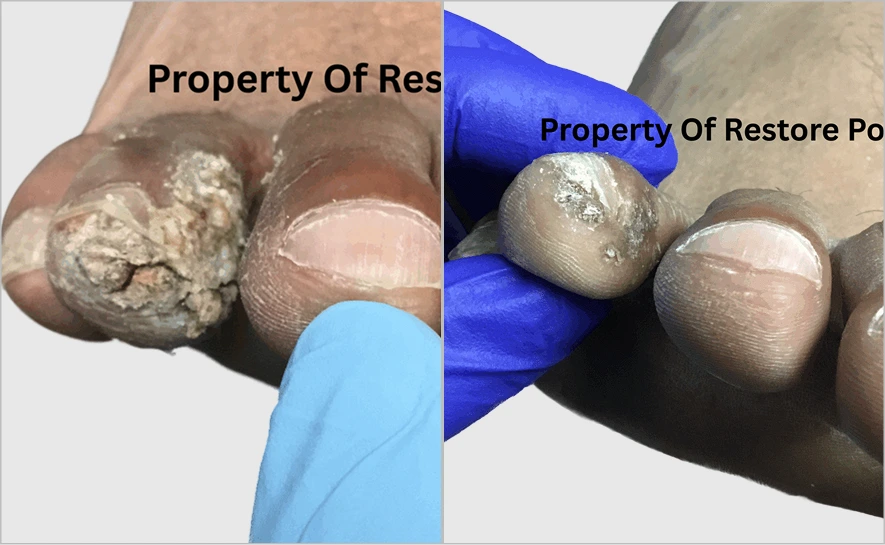 Before and after close-up of toenail with fungal infection on left, treated nail on right with gloved hand
