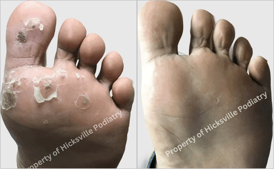 Before and after foot showing severe fungal nail infection on left, cleared nail on right