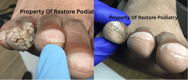 Before and after comparison of warts on fingers treated with Swift Microwave Therapy