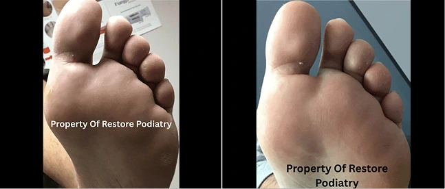 Before and after comparison of swollen foot showing reduced inflammation