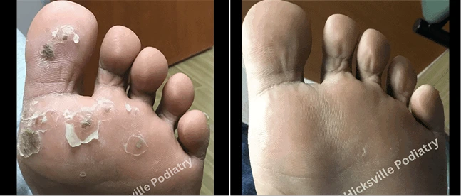 Before and after comparison of foot with peeling skin showing healing progress