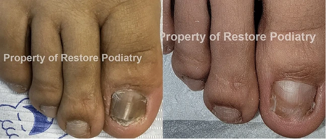 Before and after laser fungal toenail treatment comparing thick discolored nails on left with clear nails on right