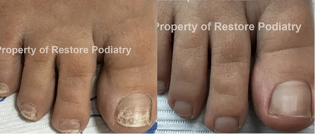 Before and after laser fungal toenail treatment showing diseased nails with discoloration on left, clear healthy nails on right