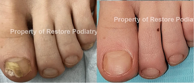 Before and after comparison of toenail fungus treatment showing cleared nail