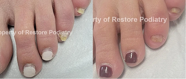 Before and after toenail treatment results at Restore Podiatry