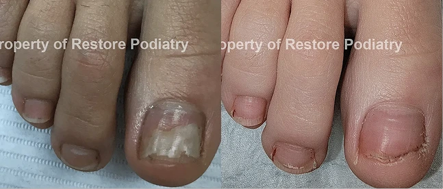 Before and after toenail fungus treatment showing diseased nail with debris on left, restored clear nail on right