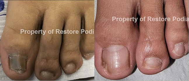 Before and after fungal toenail treatment with thick discolored nails on left, healthy clear nails on right