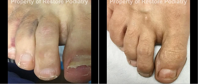 Before and after toenail fungus treatment showing damaged nails with discoloration on left, restored clear nails on right