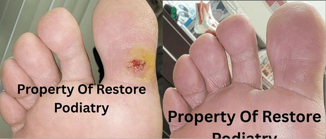 Before and after foot showing plantar wart treatment progression at Restore Podiatry