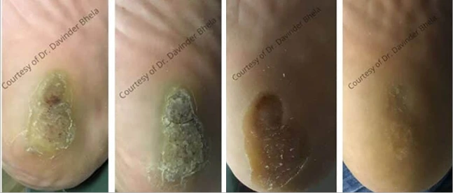 Four-stage progression of wart treatment over time, courtesy of Dr. Darren Bikhis