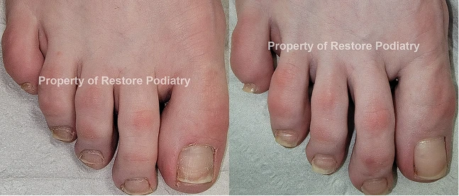 Before and after comparison of toenails showing treatment results at Restore Podiatry