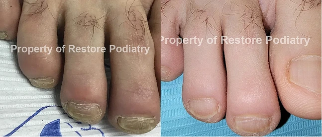 Before and after toenail treatment comparison showing nail appearance improvement