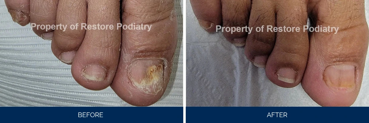 Before and after toenail fungus treatment: discolored, thick nail compared to clear, healthy nail