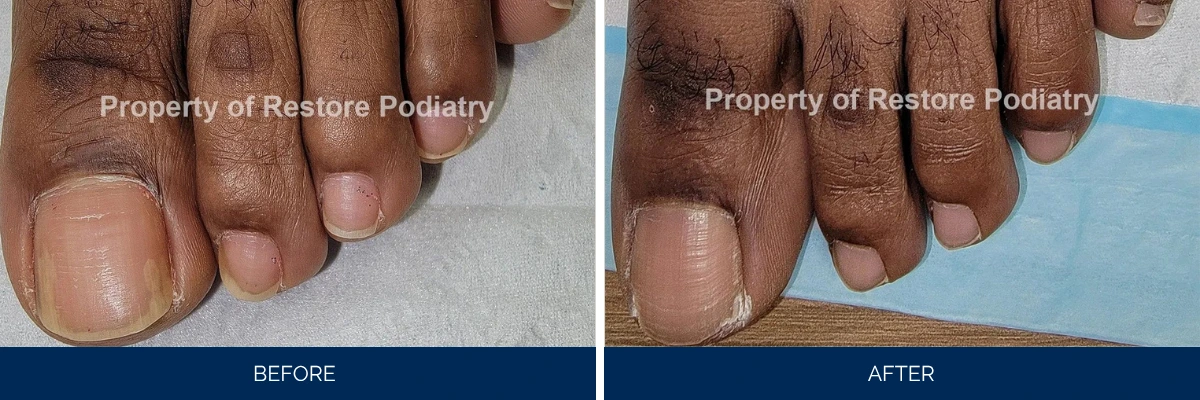 Before and after toenail fungus treatment: yellowed nail compared to restored clear nail