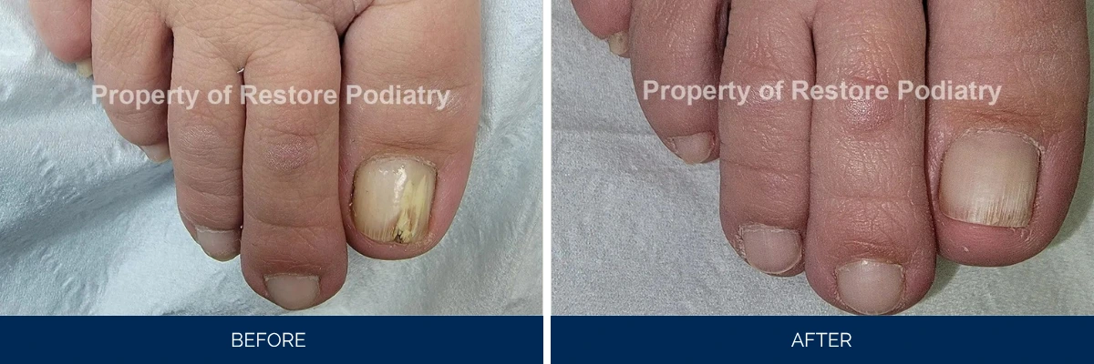 Before and after toenail fungus treatment: yellow-discolored nail compared to clear nail