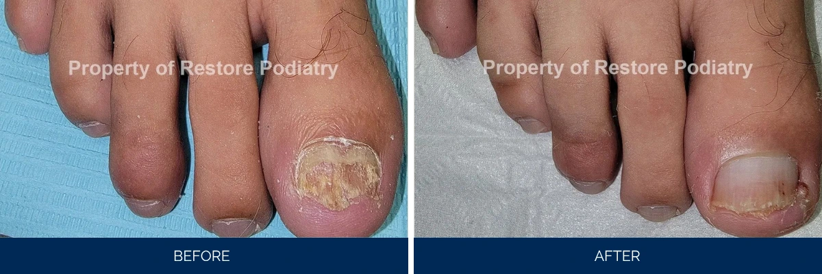Before and after toenail fungus treatment: crumbling, discolored nail compared to healthy nail