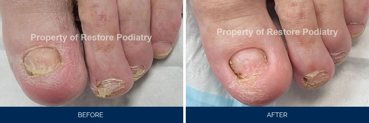 Before and after toenail fungus treatment: thick, discolored nails compared to clear, healthy nails